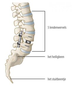 uitleg, diagnose, spondylodese
